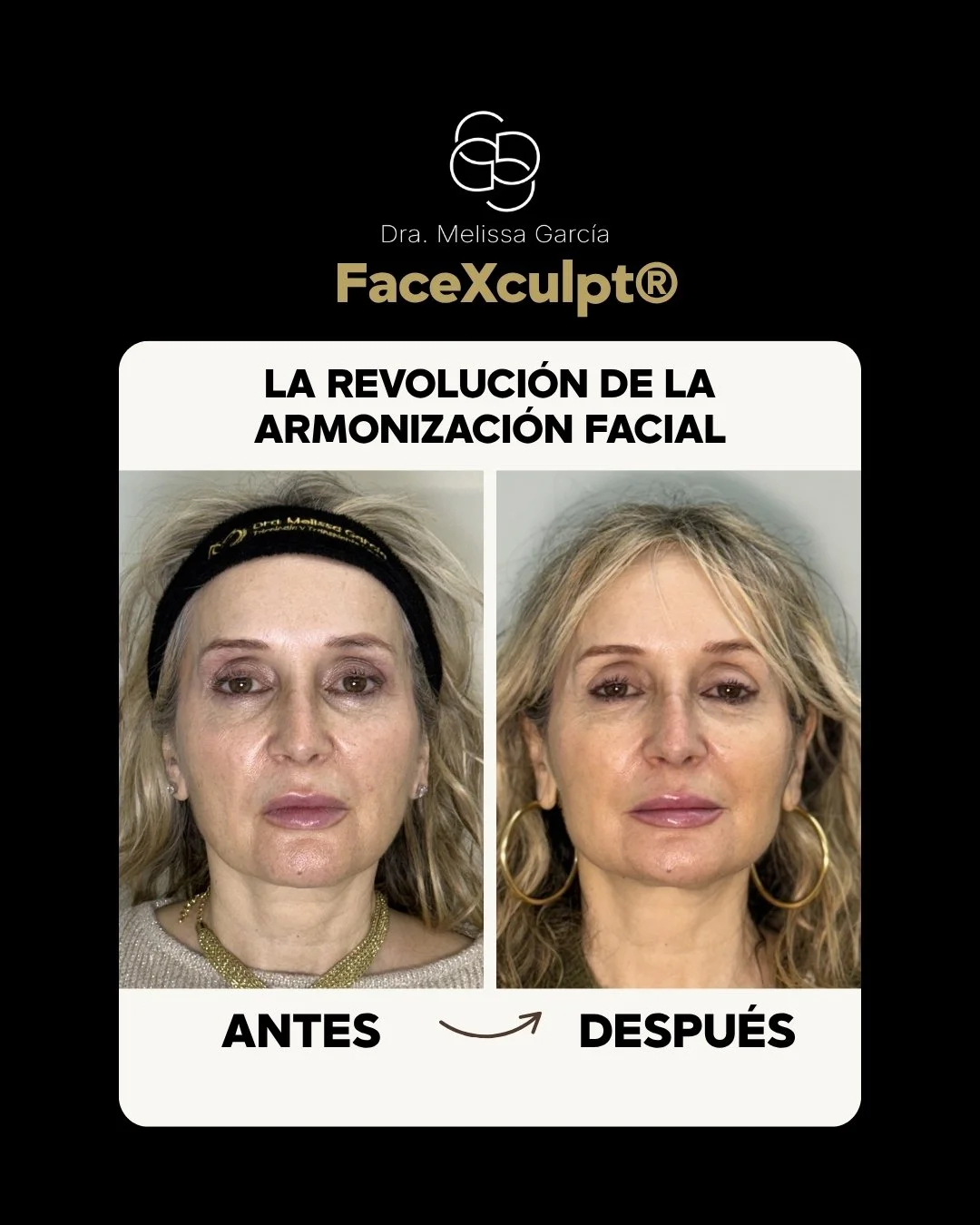 armonización facial Barcelona dra melissa garcía