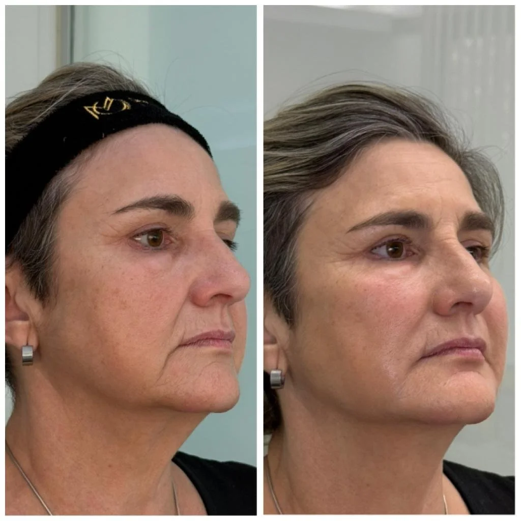 Armonización facial en Barcelona Full Face