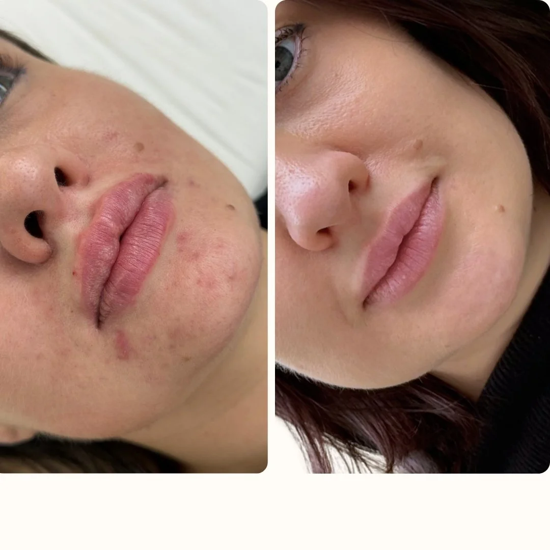 ACNÉ MEDICO EN BARCELONA