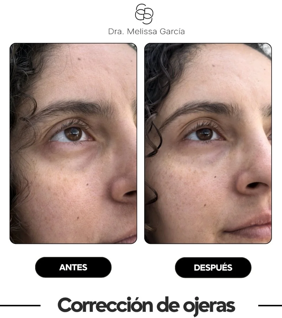 QUITAR OJERAS BARCELONA