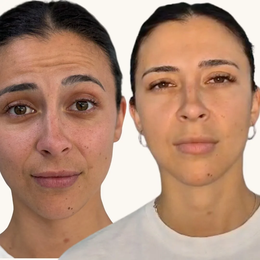 eliminar arrugas barcelona medicina estetica dra melissa garcia