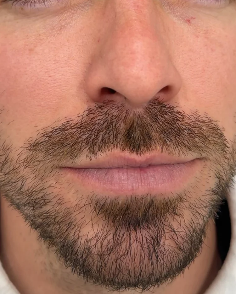 Después tratamiento facial