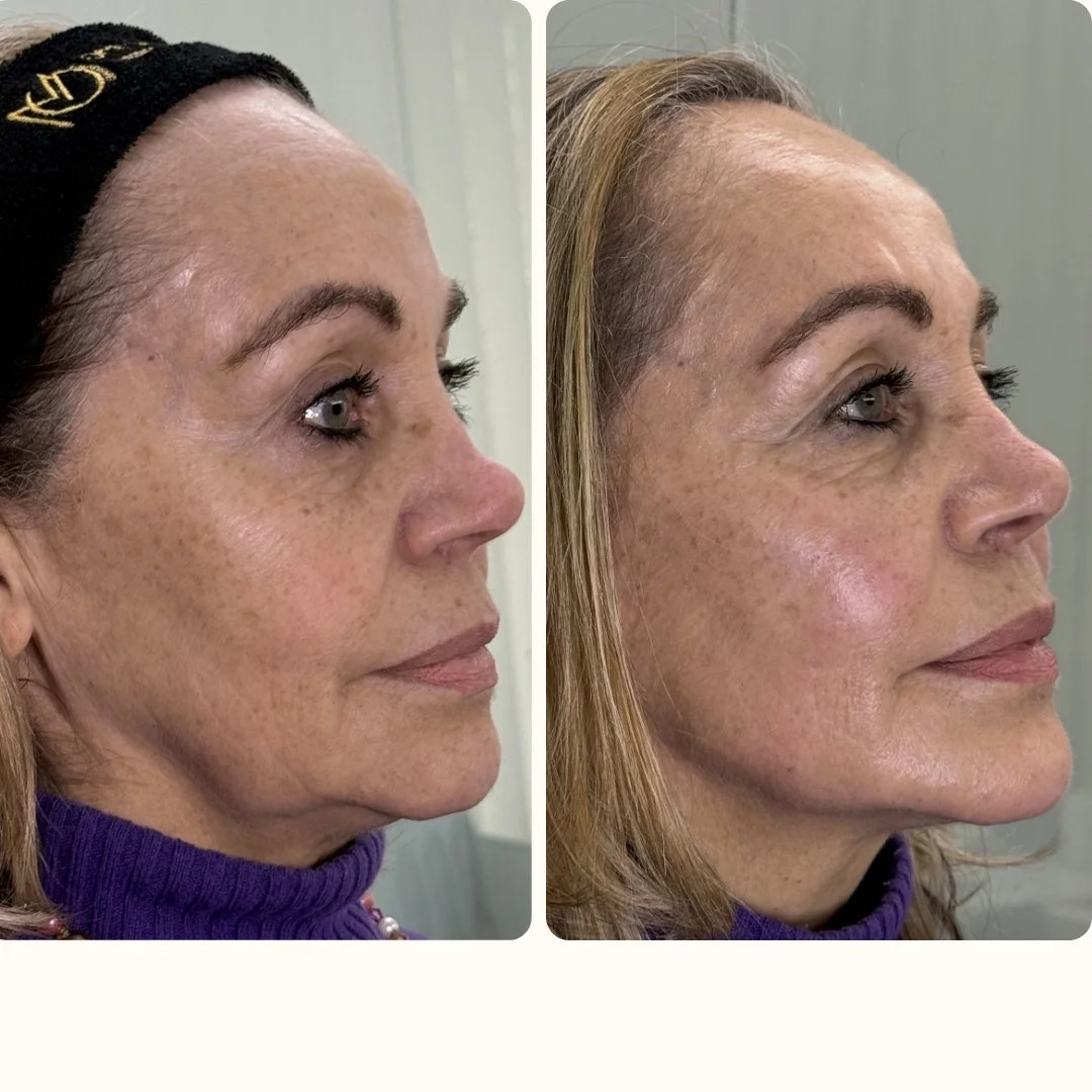 LIFTING SIN CURIGÍA DRA.MELISSA GARCÍA BARCELONA