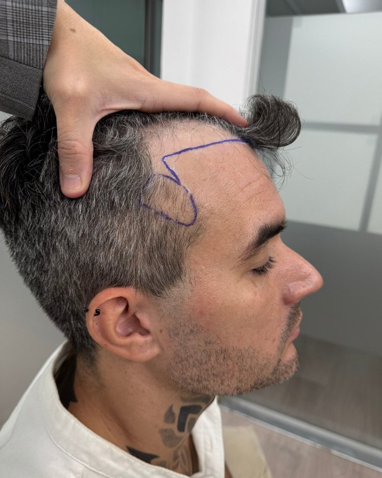 Antes injerto capilar