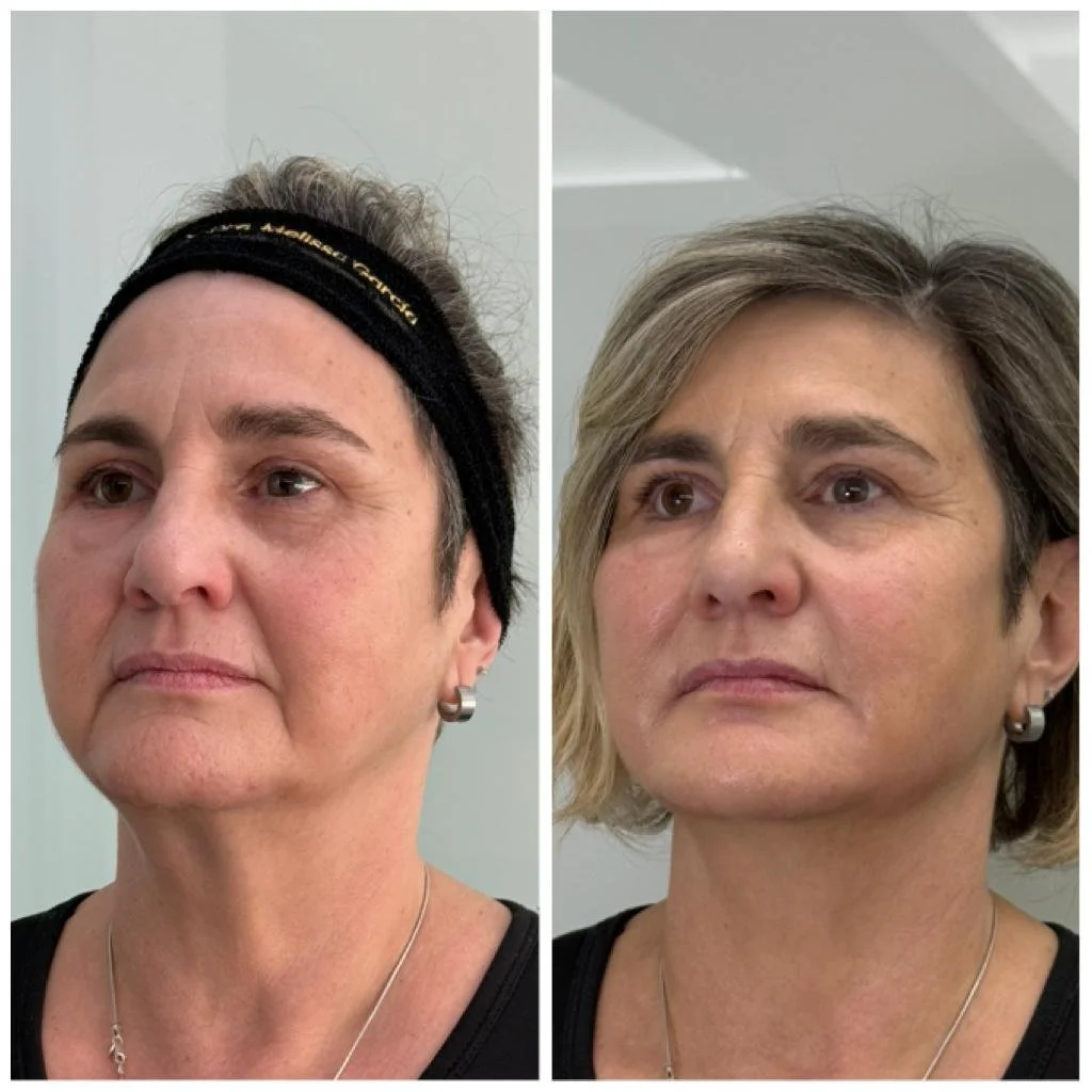 Armonización facial en Barcelona Full Face