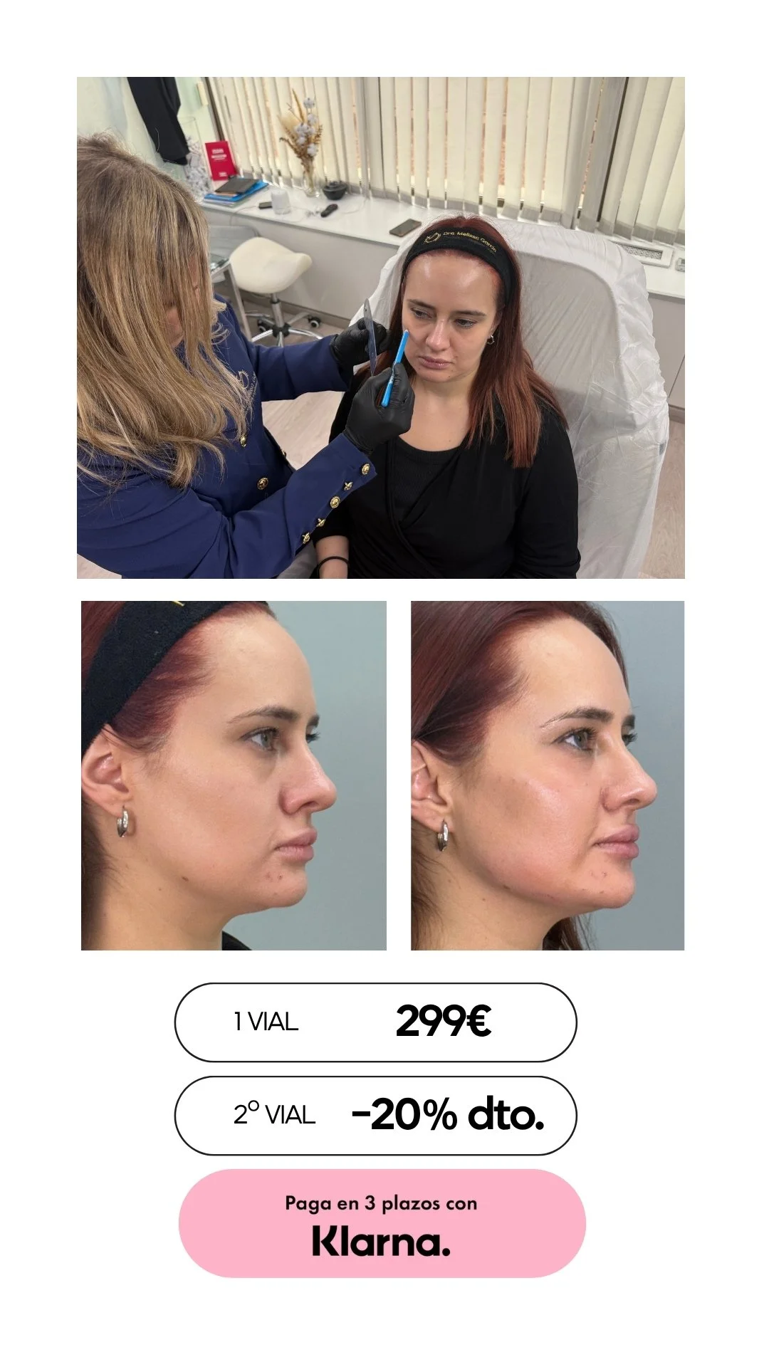 ARMONIZACIÓN FACIAL BARCELONA