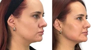 ARMONIZACIÓN FACIAL- FaceXculpt®