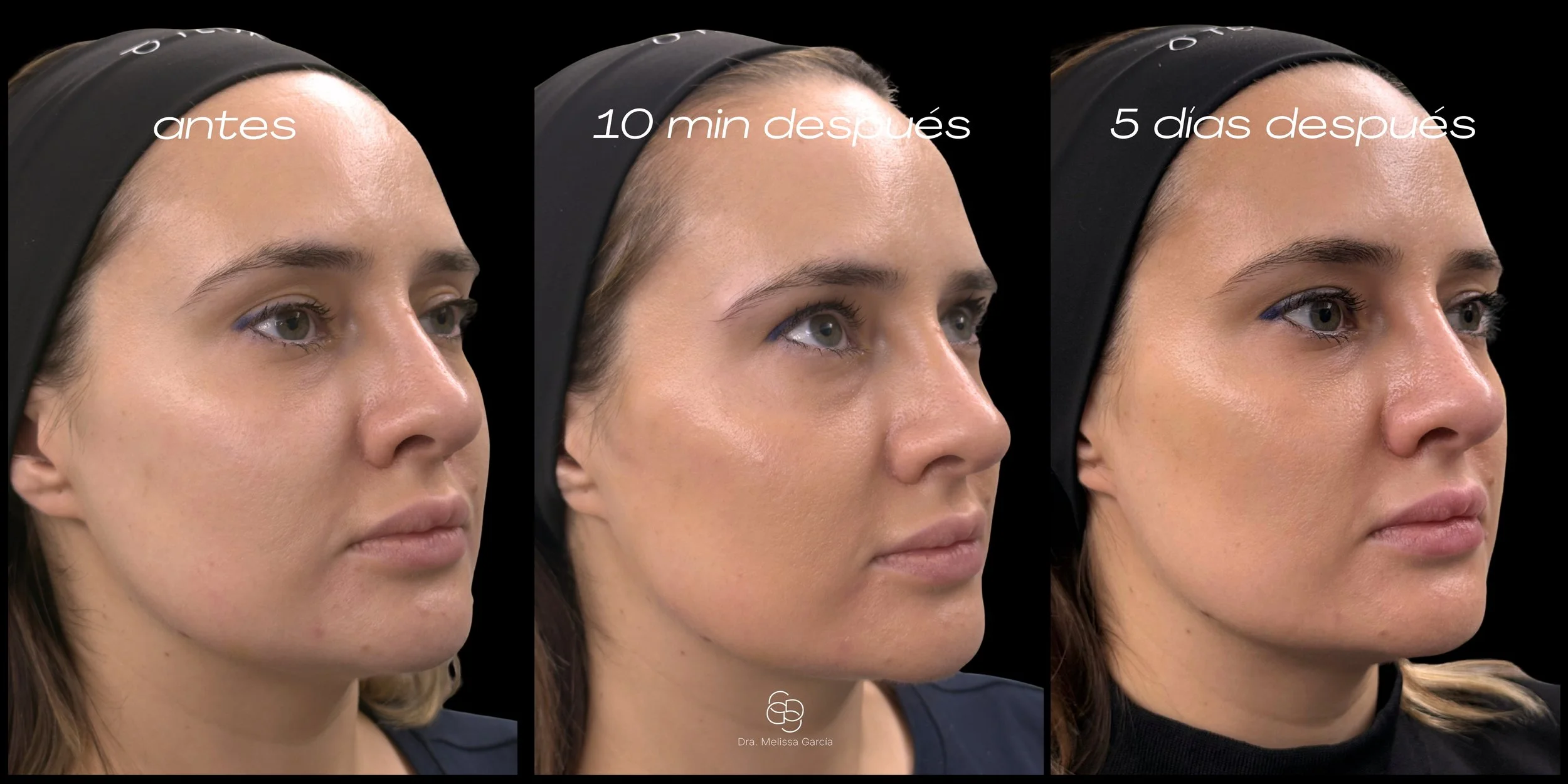 TEOXANE® BabyGLOW