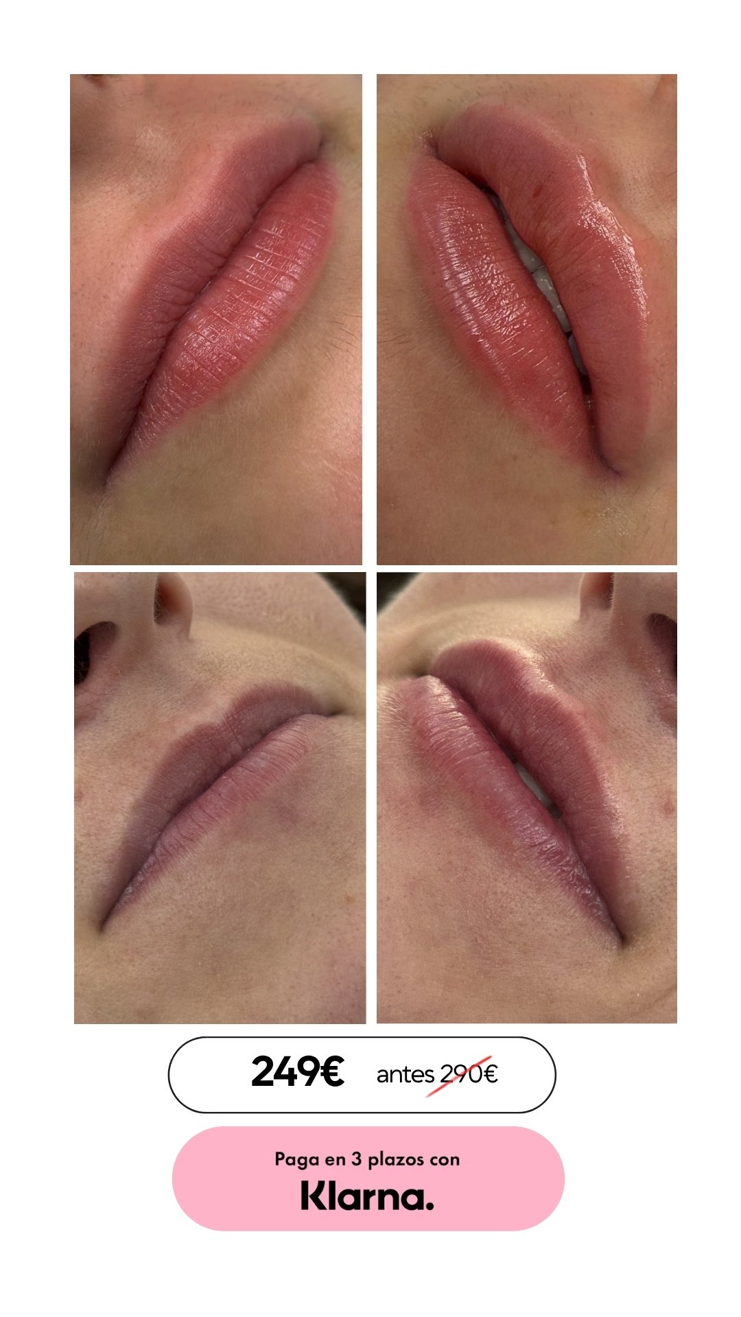 aumento de labios en barcelona