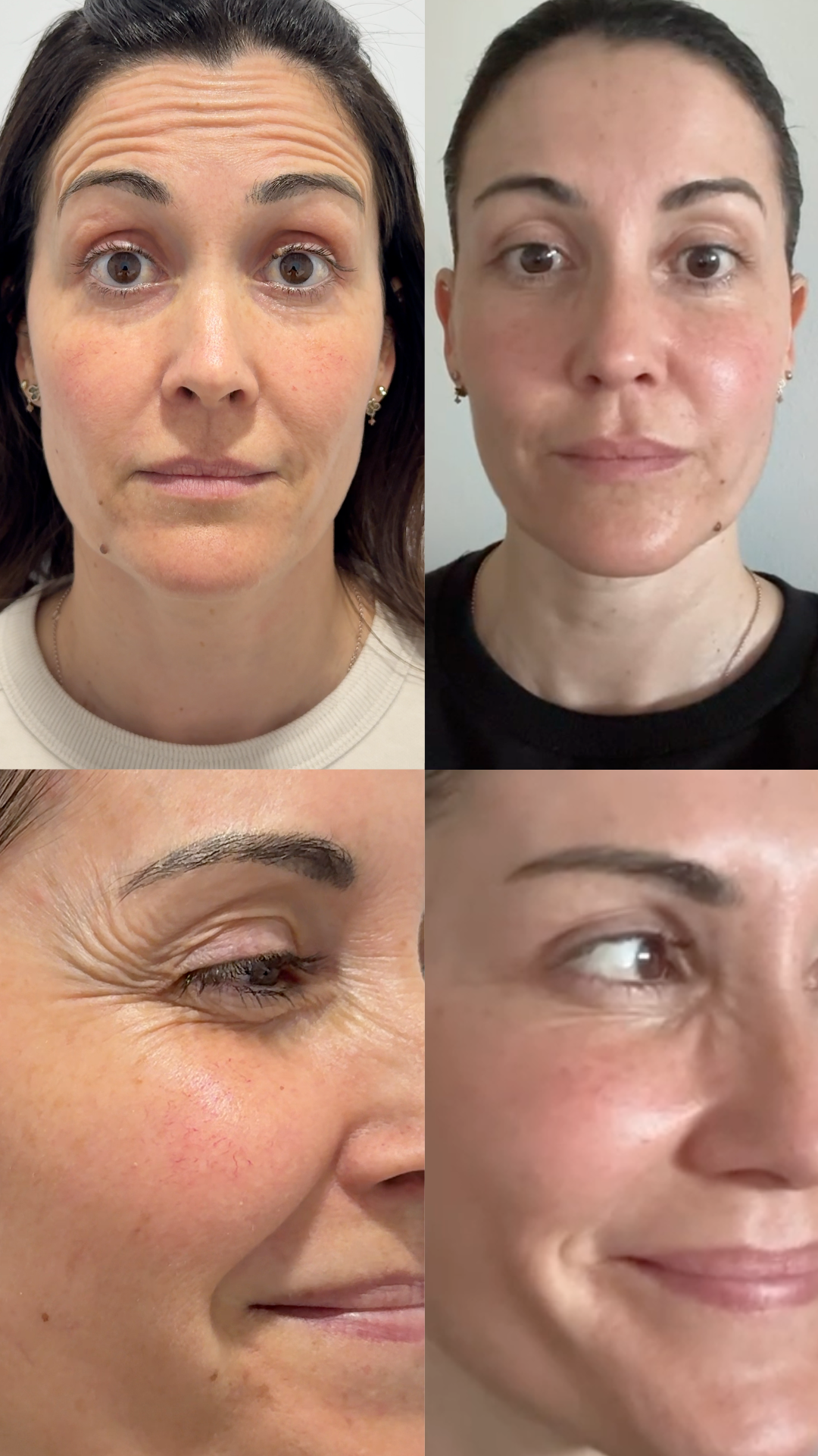 BOTOX BARCELONA
