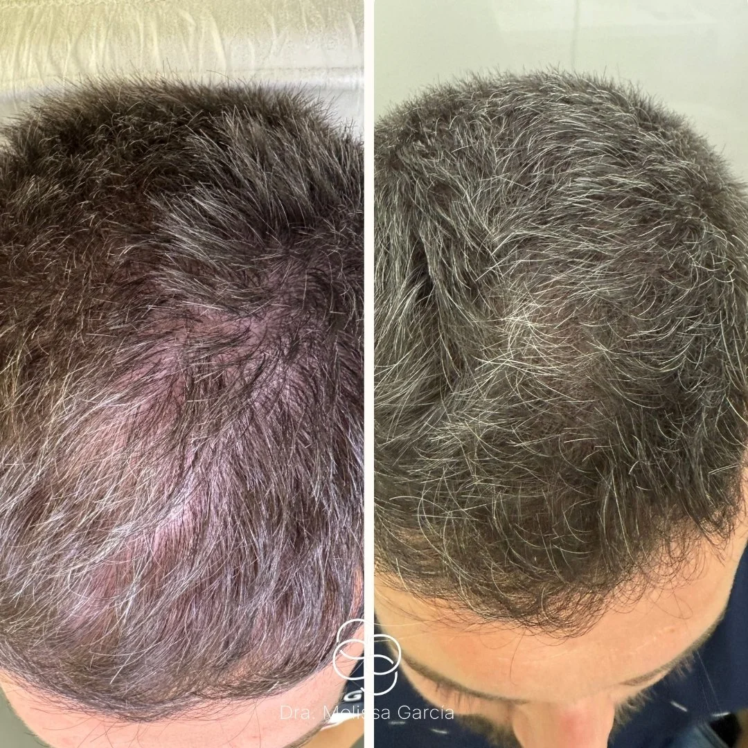 mesoterapia capilar barcelona