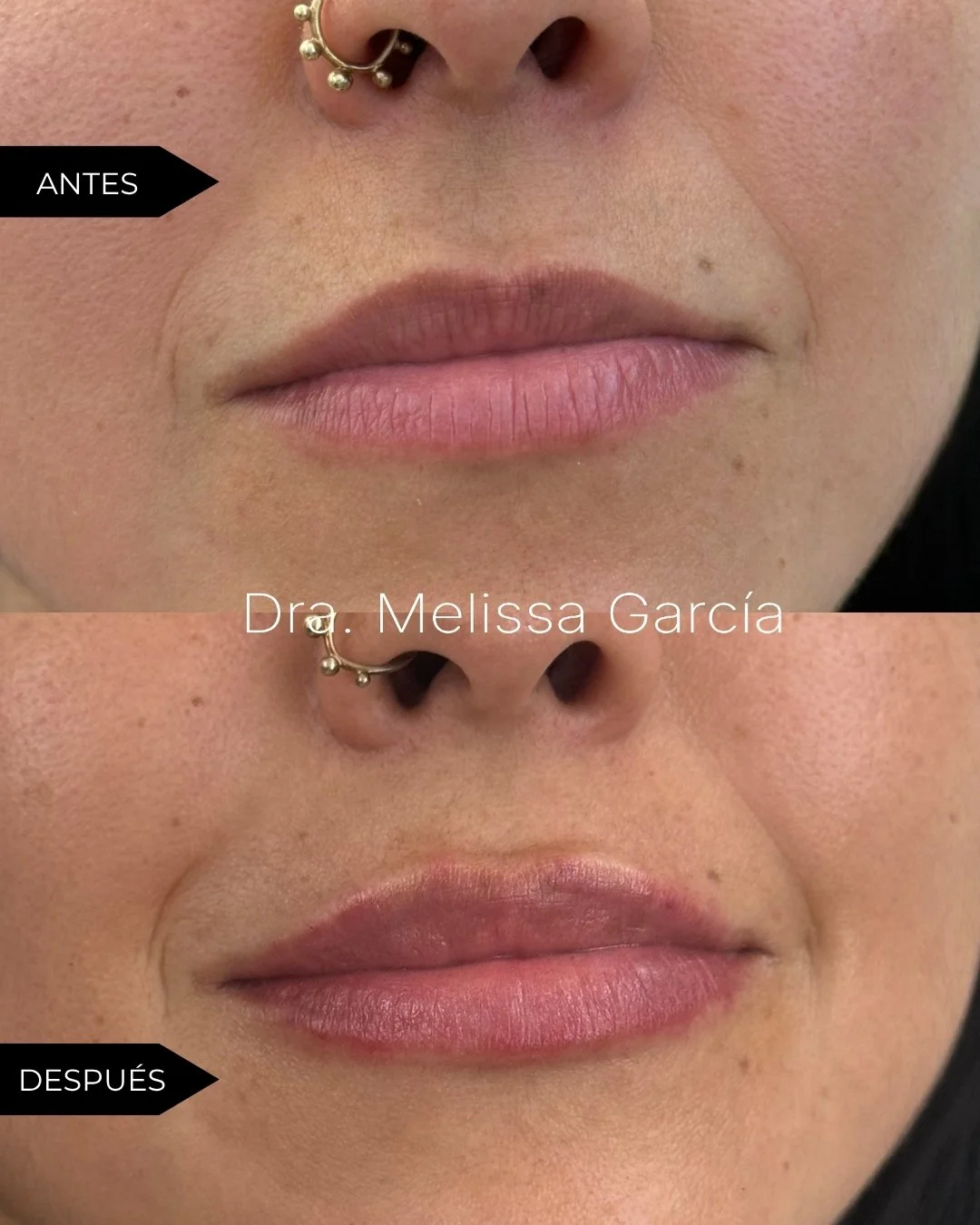AUMENTO DE LABIOS EN BARCELONA