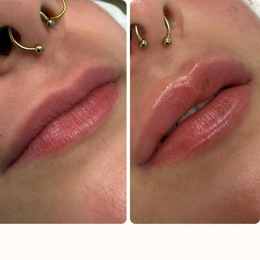 Aumento de labios en Barcelona