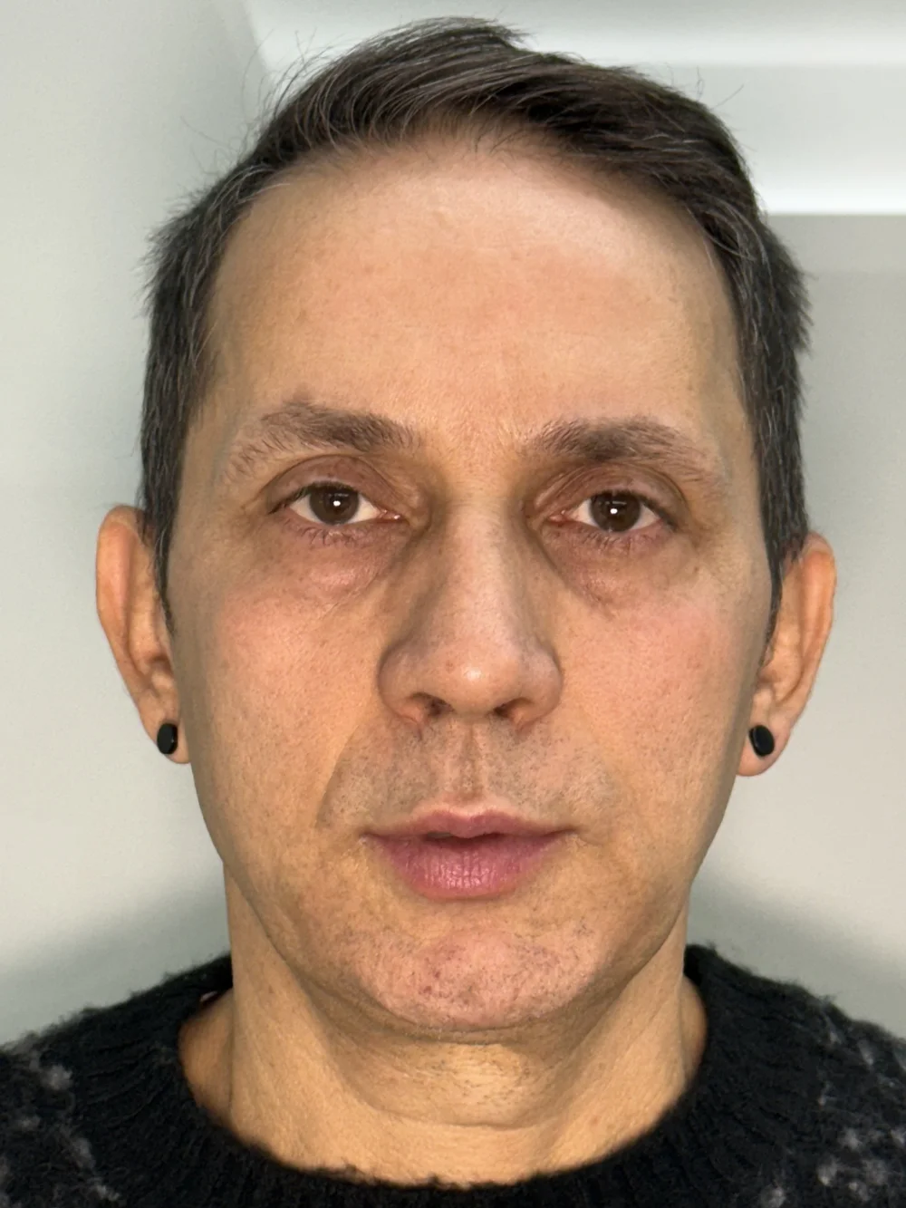 Antes tratamiento facial