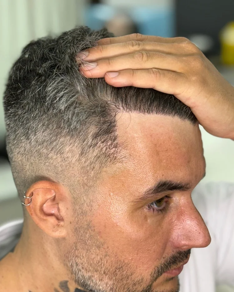 Después injerto capilar