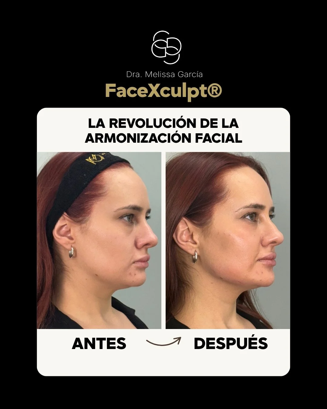 armonización facial Barcelona dra melissa garcía