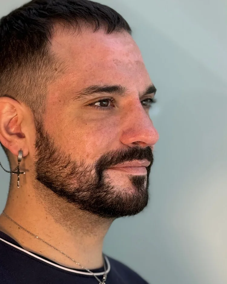 Después rinomodelación