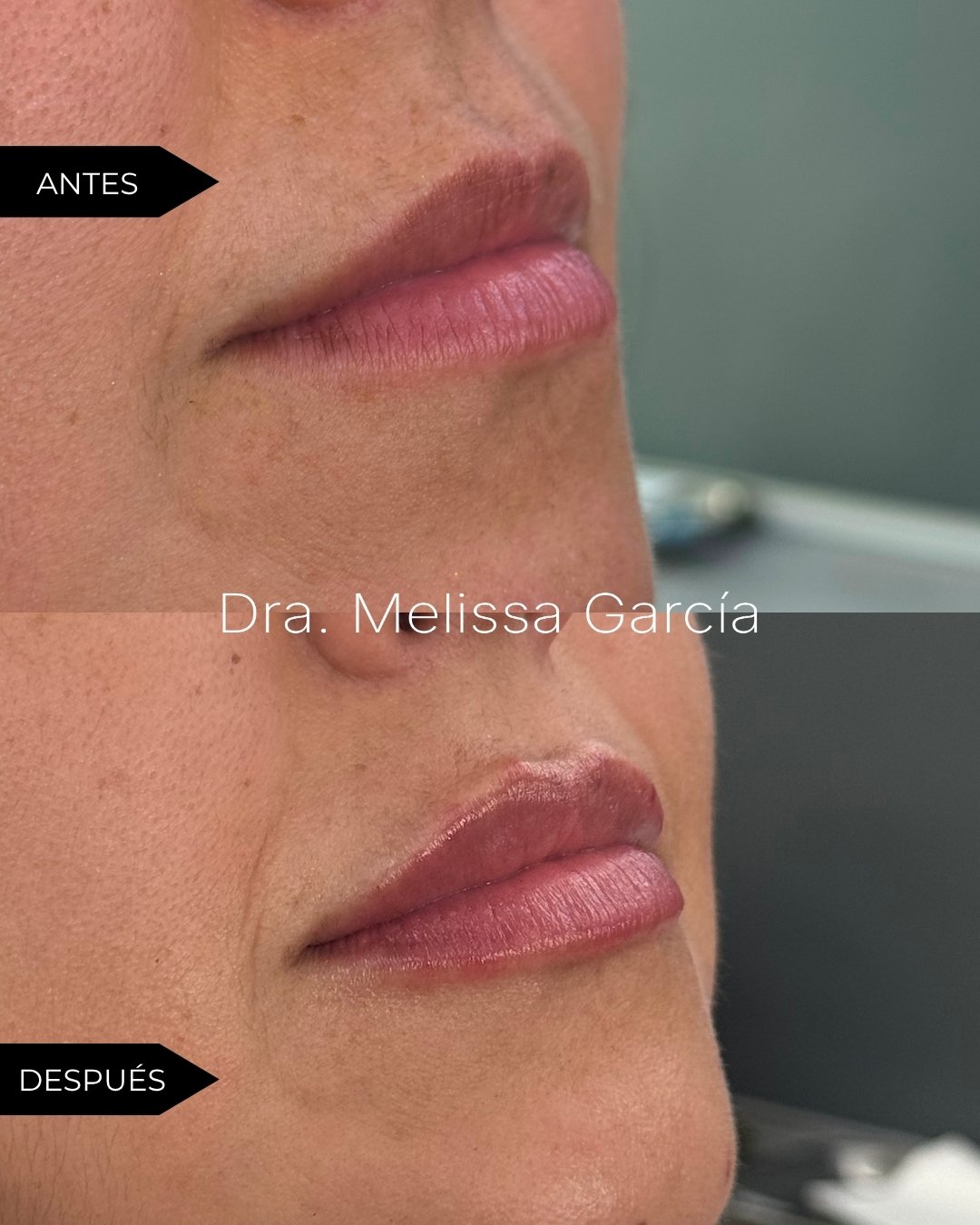 AUMENTO DE LABIOS EN BARCELONA