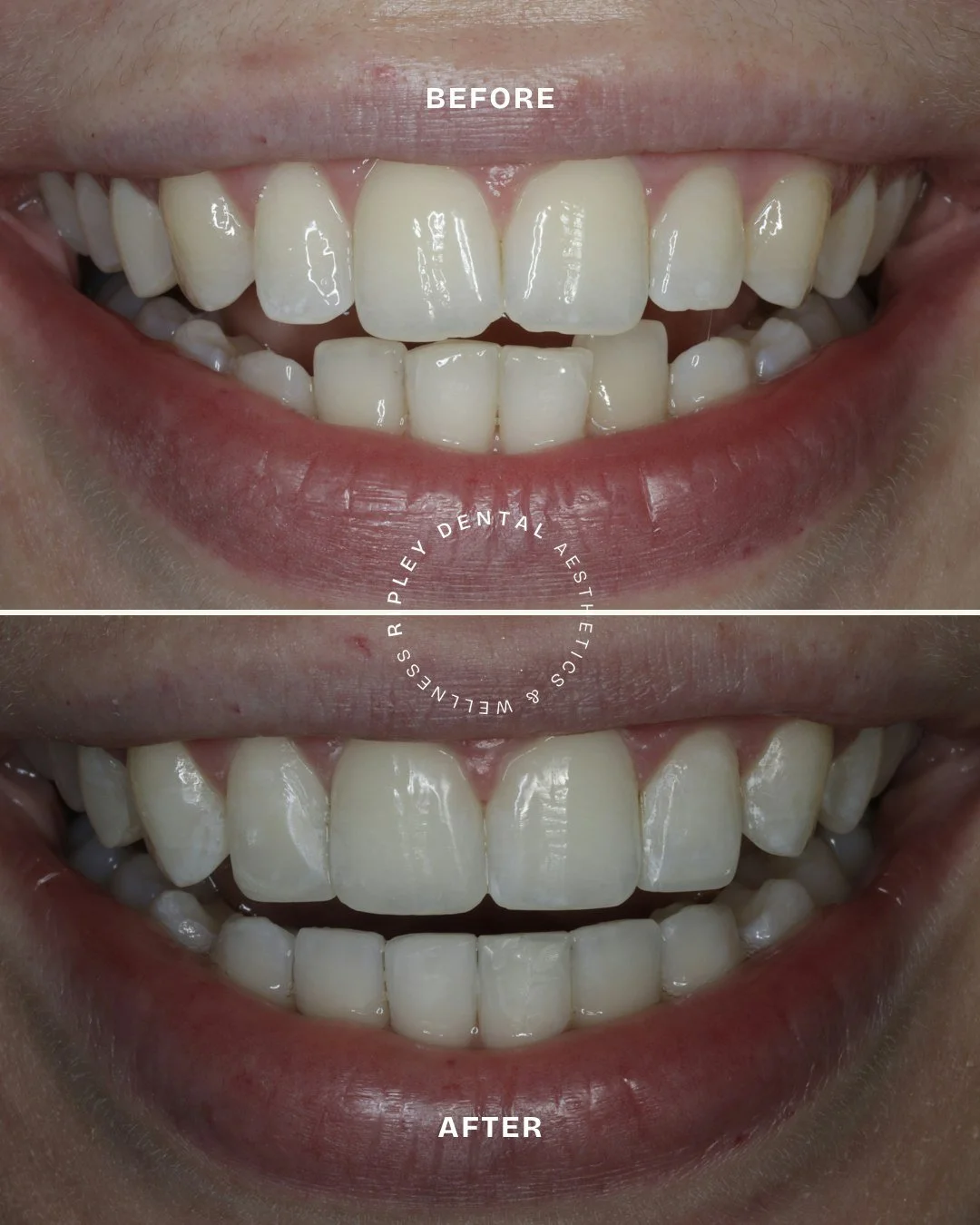 A beautiful example of how the right changes can make such a difference to a smile 🤍

For this patient, we focused on closing the gaps and creating a more even, natural-looking finish &mdash; while keeping the character of their smile.

If there&rsq