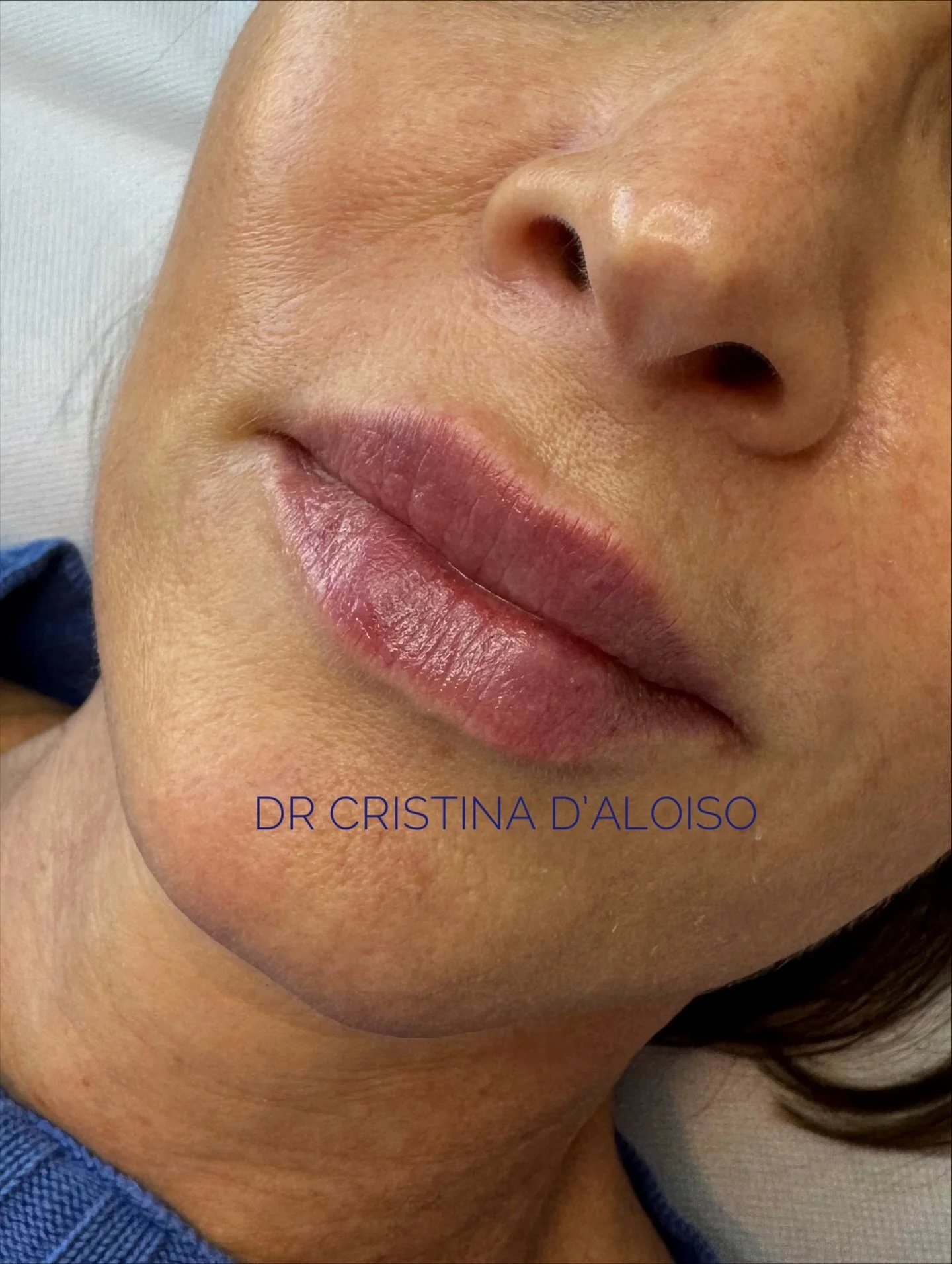 Lip beautification ๐ and skin quality care ๐ฉบ
Lipfiller per il miglioramento di armonia, proporzioni, forma ed idratazione delle labbra e biostimolazione mensile con skinbooster per la cura della skin quality ๐♥๏ธ
Innamorate di questo risu
