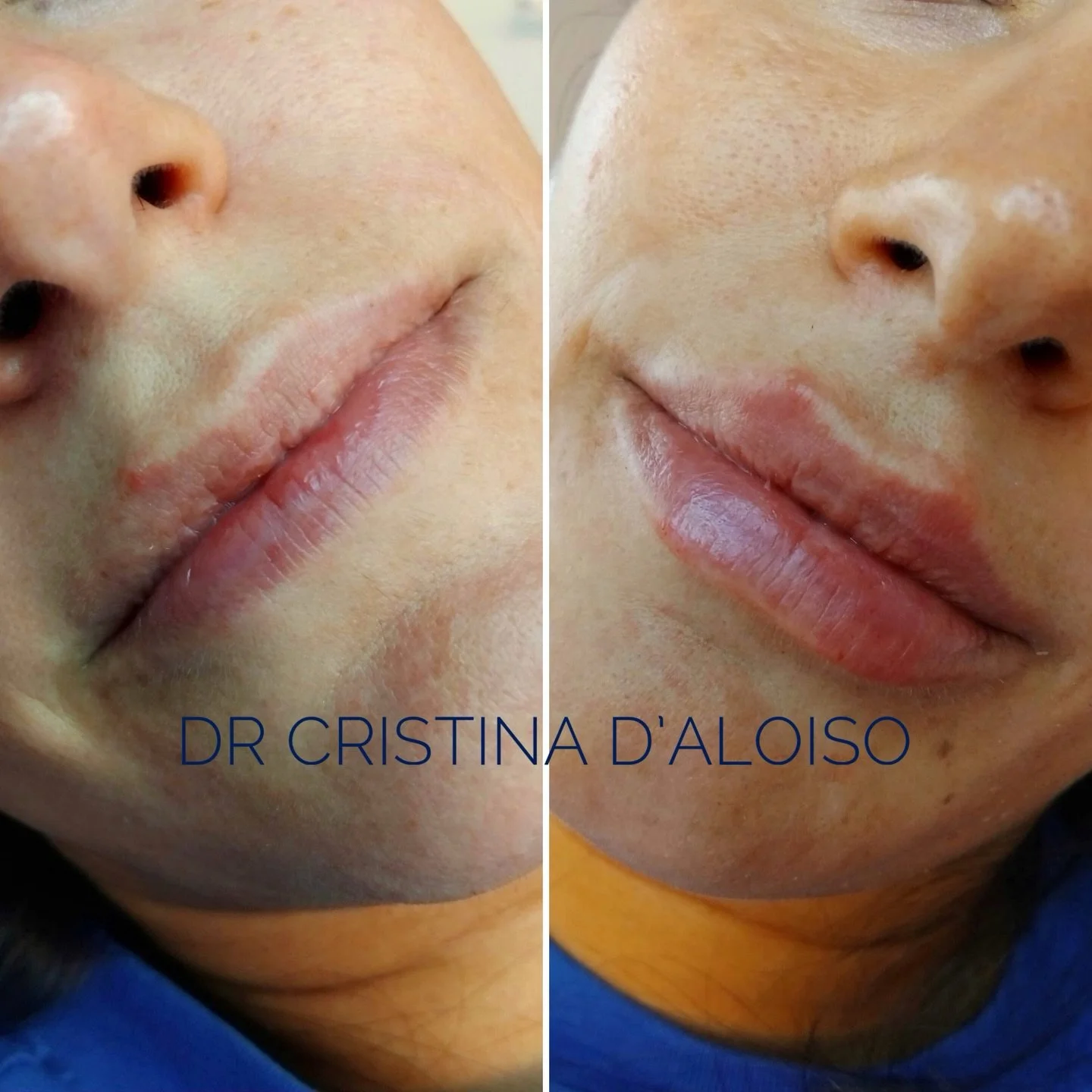 Lips&rsquo; beautification &hearts;️

🩺 analisi molto attenta 
💉 cura delle proporzioni 
🔬 definizione dei dettagli
🧬 utilizzo dei migliori dispositivi medici 
🗓️ durata di circa 12 mesi
🧐 tecnica personalizzata per ogni paziente
❌ solo risulta