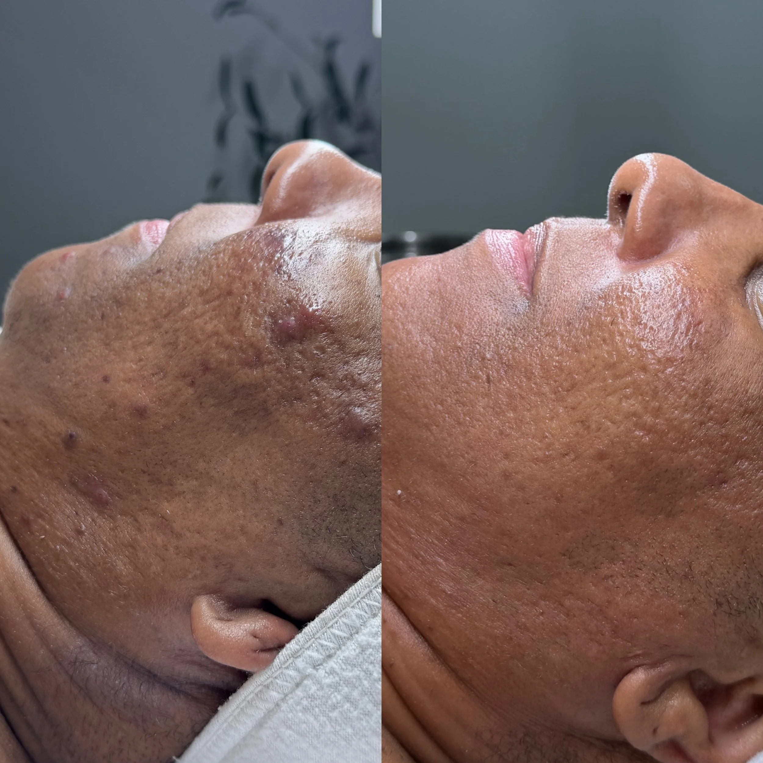 This transformation is more than a before &amp; after for me. It&rsquo;s a reminder that deeper skin tones can achieve beautiful skin transformations&hellip; with patience, consistency, and an approach that respects your skin every step of the way. ?