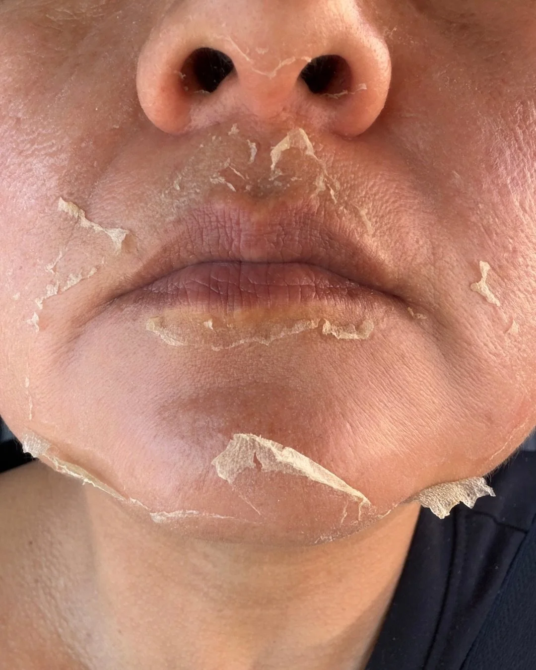 Peel season is here! 🤎✨🍂🍁

The ZO 3-Step Peel is one of our favorite treatments for improving uneven skin tone, hyperpigmentation, acne, and overall skin texture.

But here&rsquo;s the thing: great results start with proper skin preparation! Not e