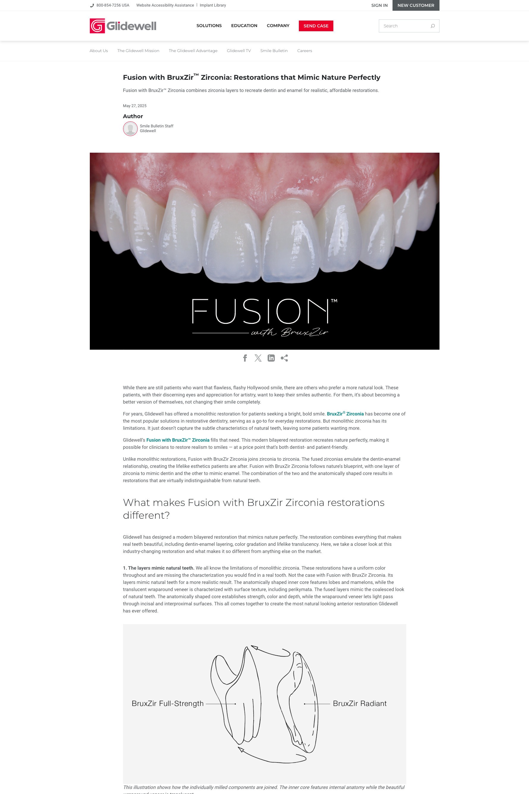Glidewell+Blog+Fusion+with+BruxZir.png