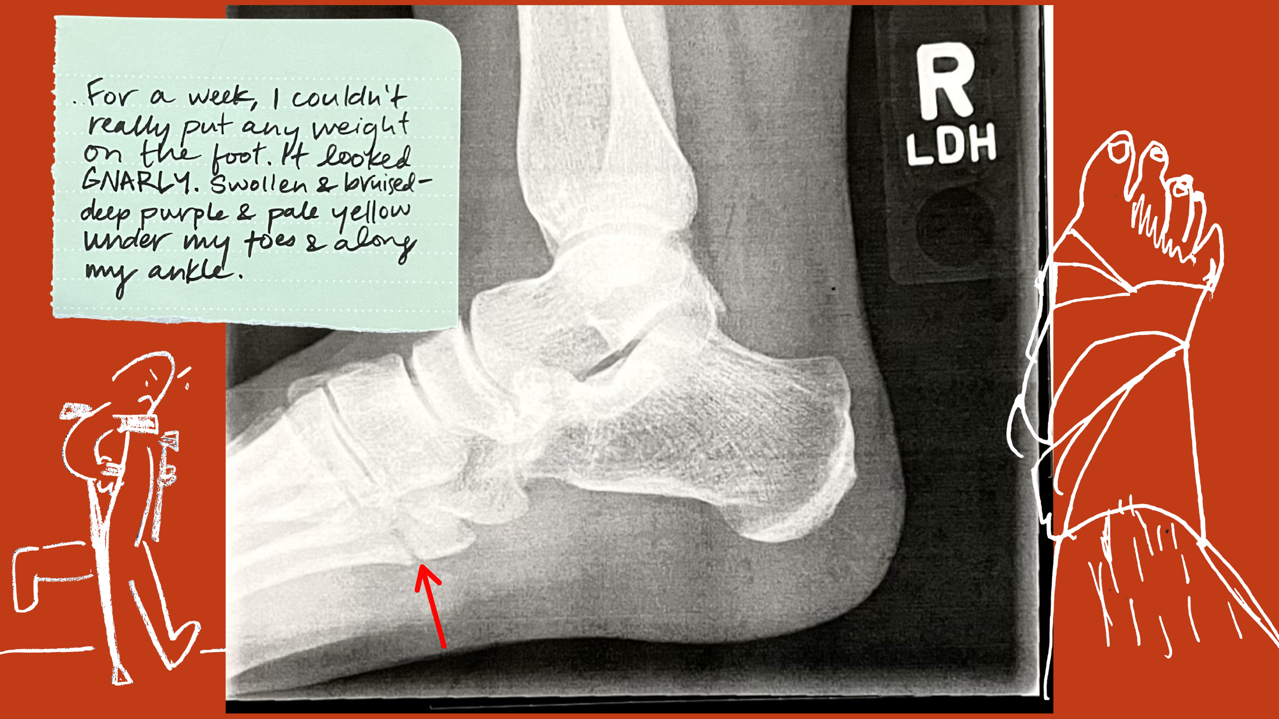 🩻i broke my foot 🩼🤕