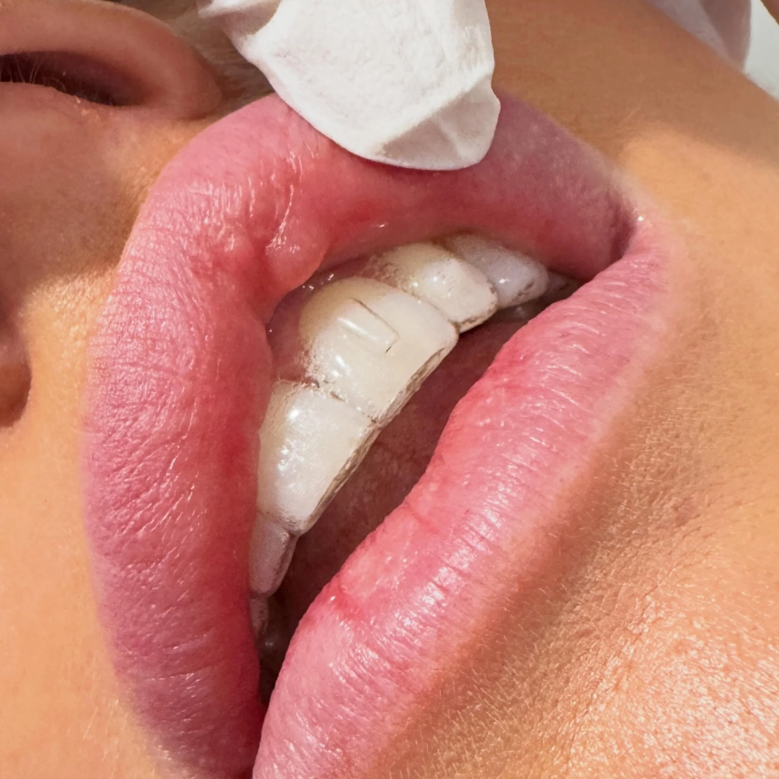 If your nurse isn&rsquo;t sticking their fingers in your mouth prior to treatment, you might want to reconsider 😏

I&rsquo;m looking for:
 + Blood vessels and vascular anatomy
 + Signs of lip biting or chronic trauma
 + Excess tissue or irregulariti