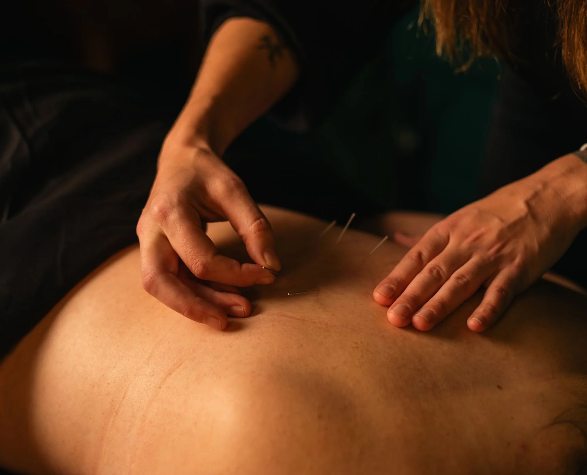 Registered acupuncturist placing acupuncture needles along the back at The Den Wellness Collective in Vancouver