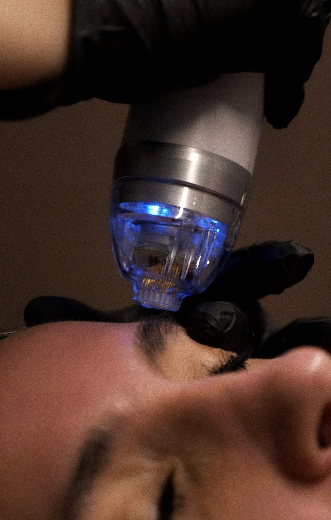 Microneedling vs. RF Microneedling: What Actually Matters