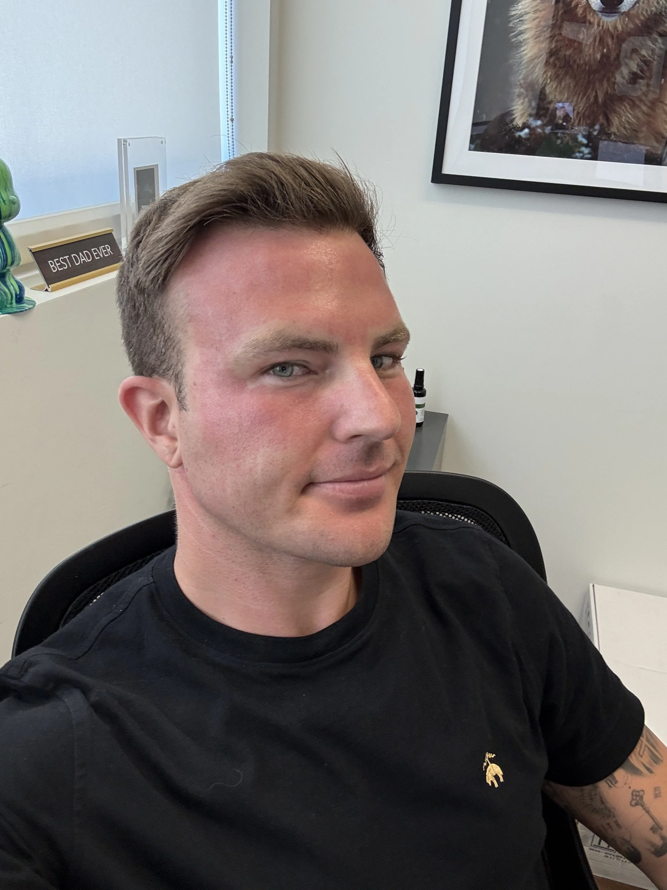 CoolPeel recovery immediately after treatment, pink and flushed cheeks on a male patient at The Perfect Secret in Scottsdale