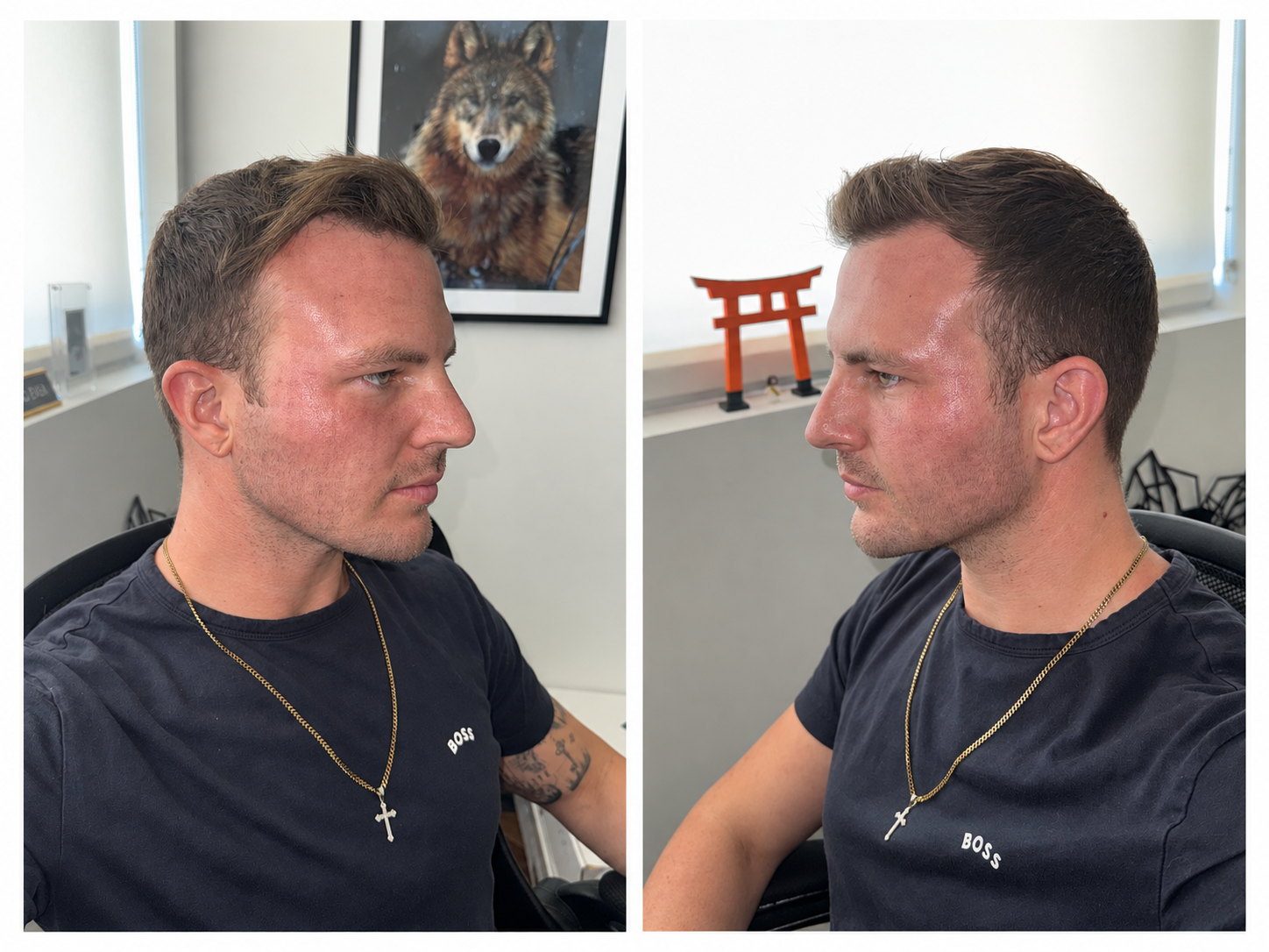CoolPeel recovery at 48 hours, left and right side profiles showing redness beginning to fade and a windburn-like texture