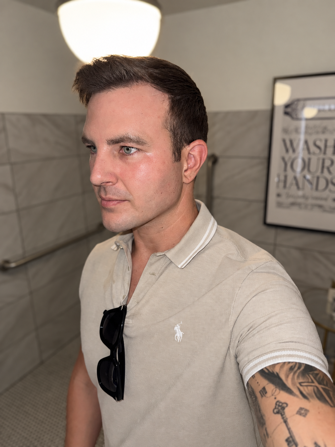 CoolPeel recovery on day six, redness and treatment marks faded with fresh, smooth skin after light peeling