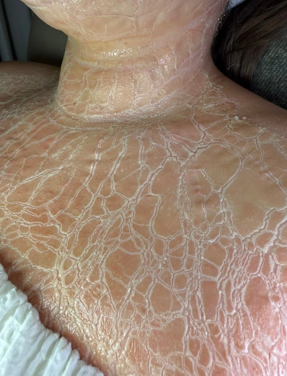 DMK Enzyme facial treatment on the neck and chest at a medspa in Mendota Heights near Minneapolis, helping tighten skin and improve overall texture.