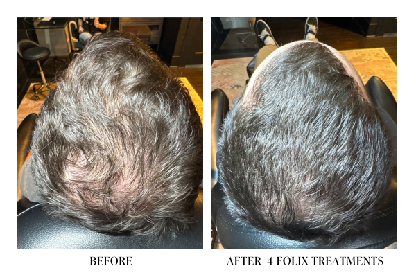 Comparison of a person's scalp before and after four Folix treatments showing improved hair density and coverage.