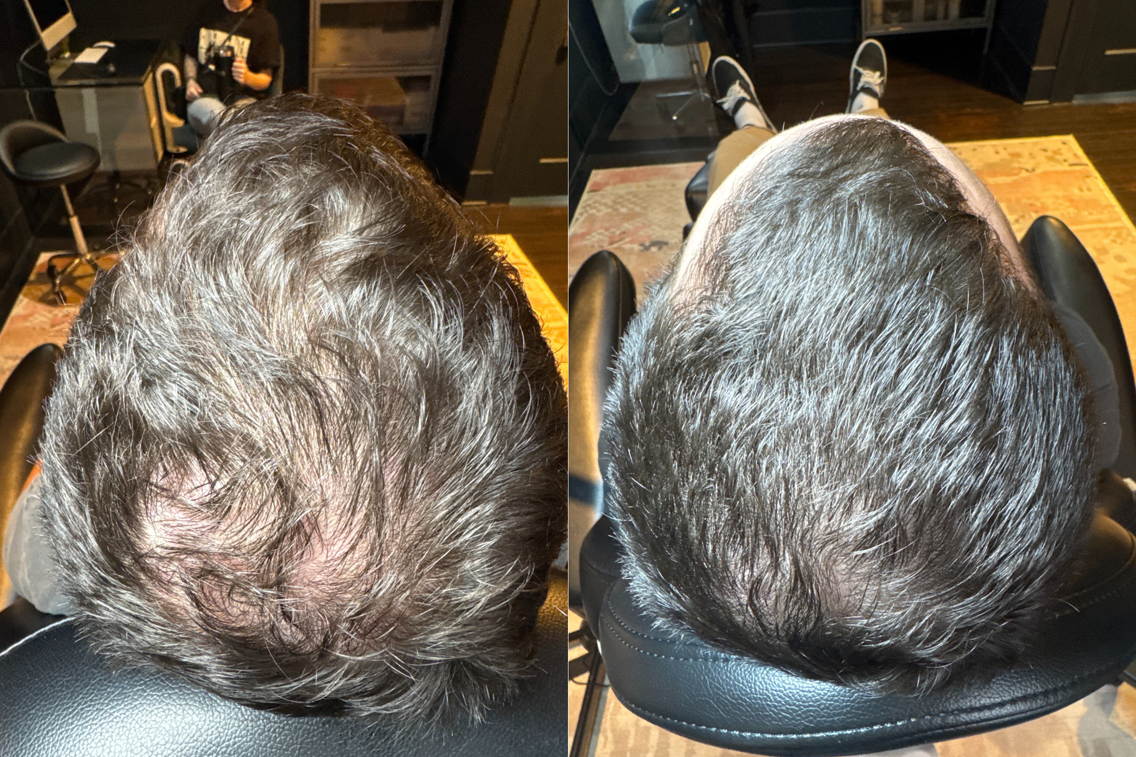 Before and After FoLix Hair Restoration Treatment Male Client in Austin, Texas