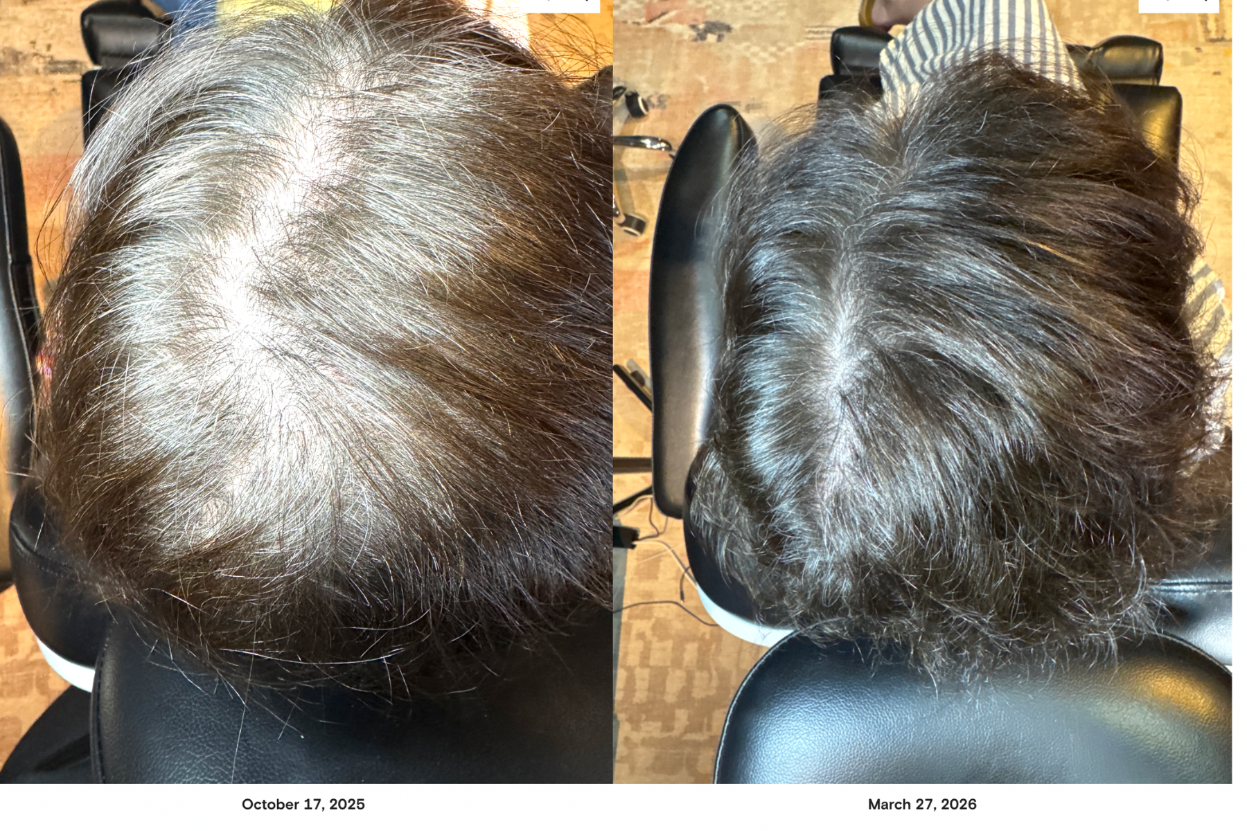 Client after FoLix non-ablative laser therapy treatment for hair growth
