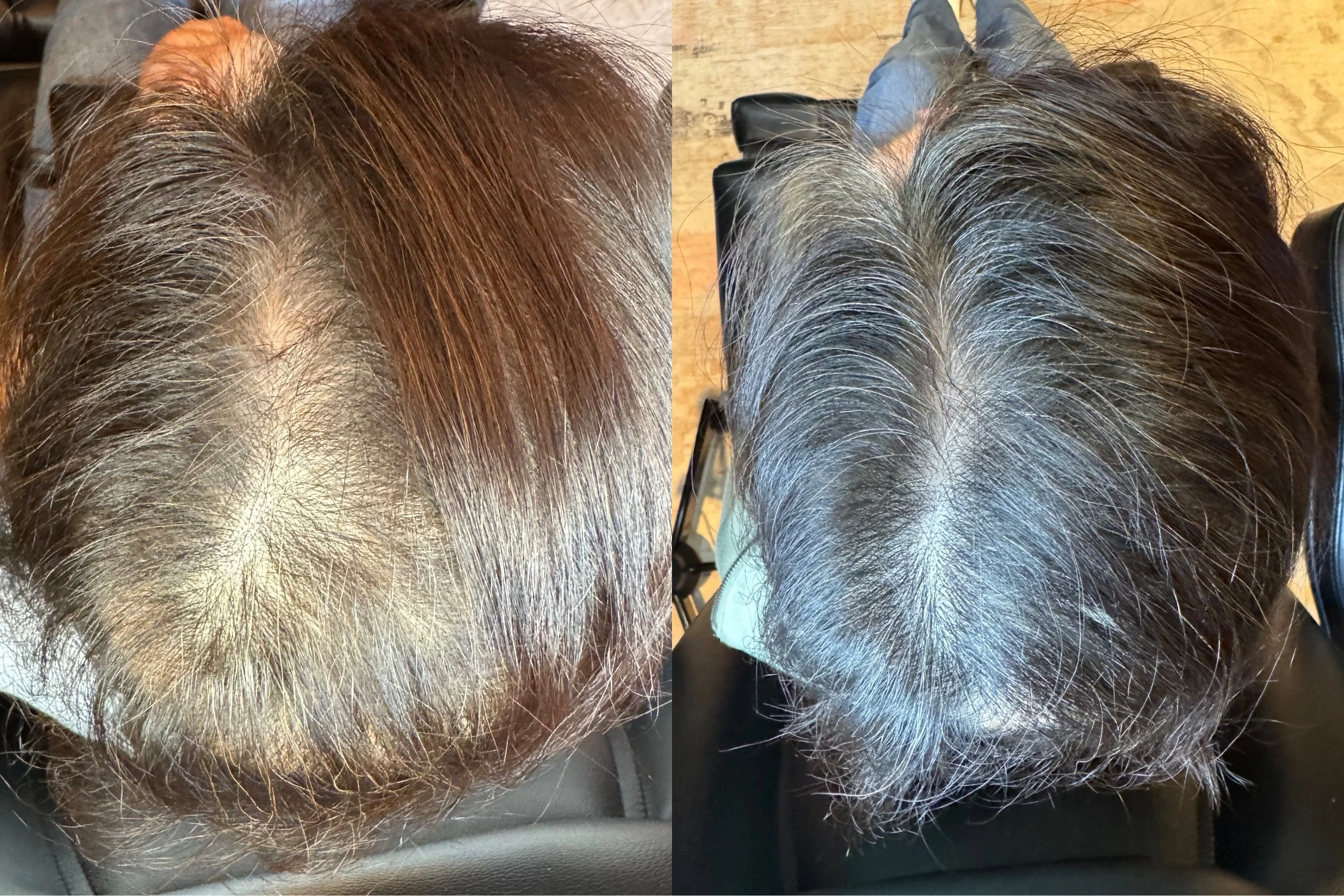 Before and After FoLix Hair Restoration Treatment Female Client in Austin, Texas