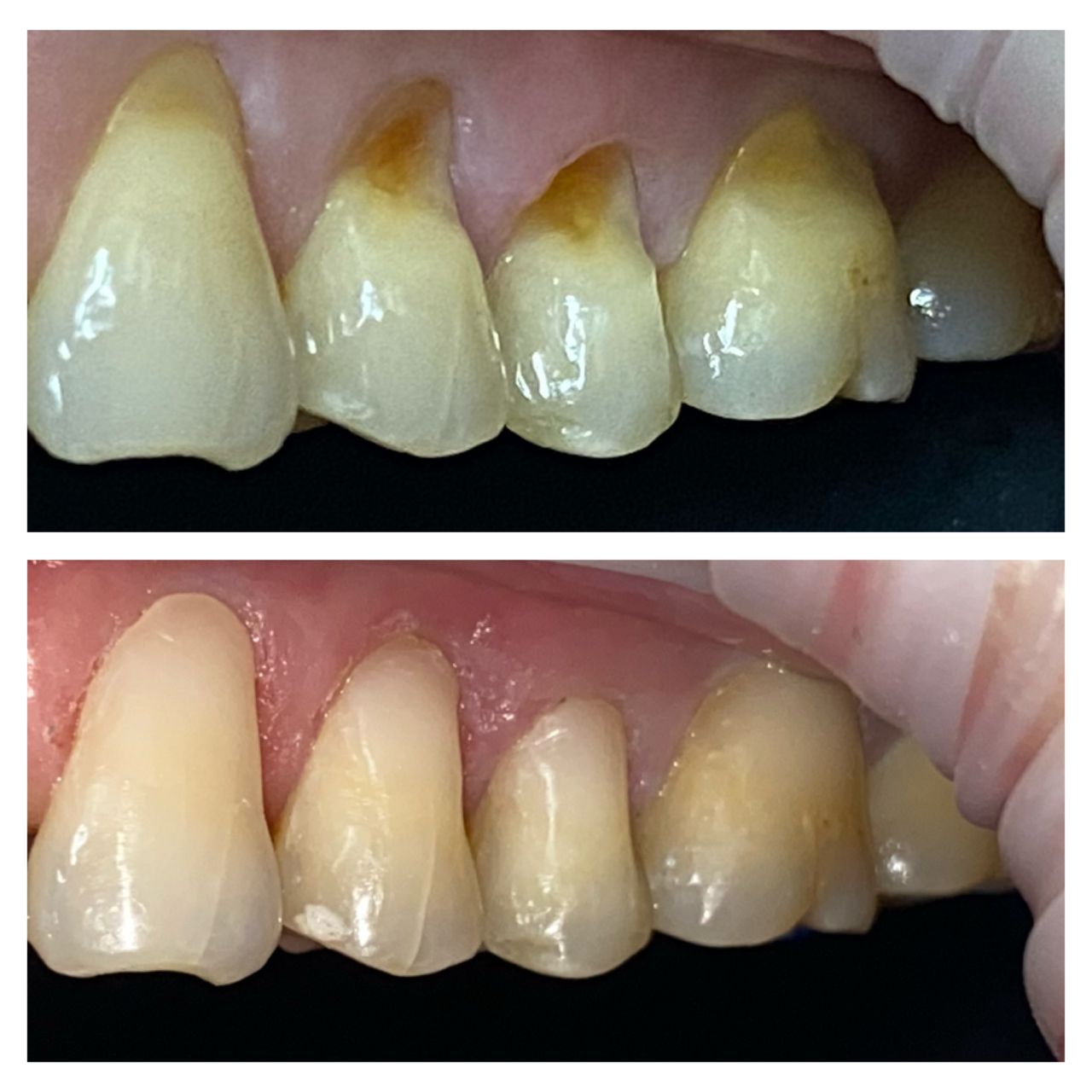 Understanding Gum Recession: Causes, Symptoms, and Treatment