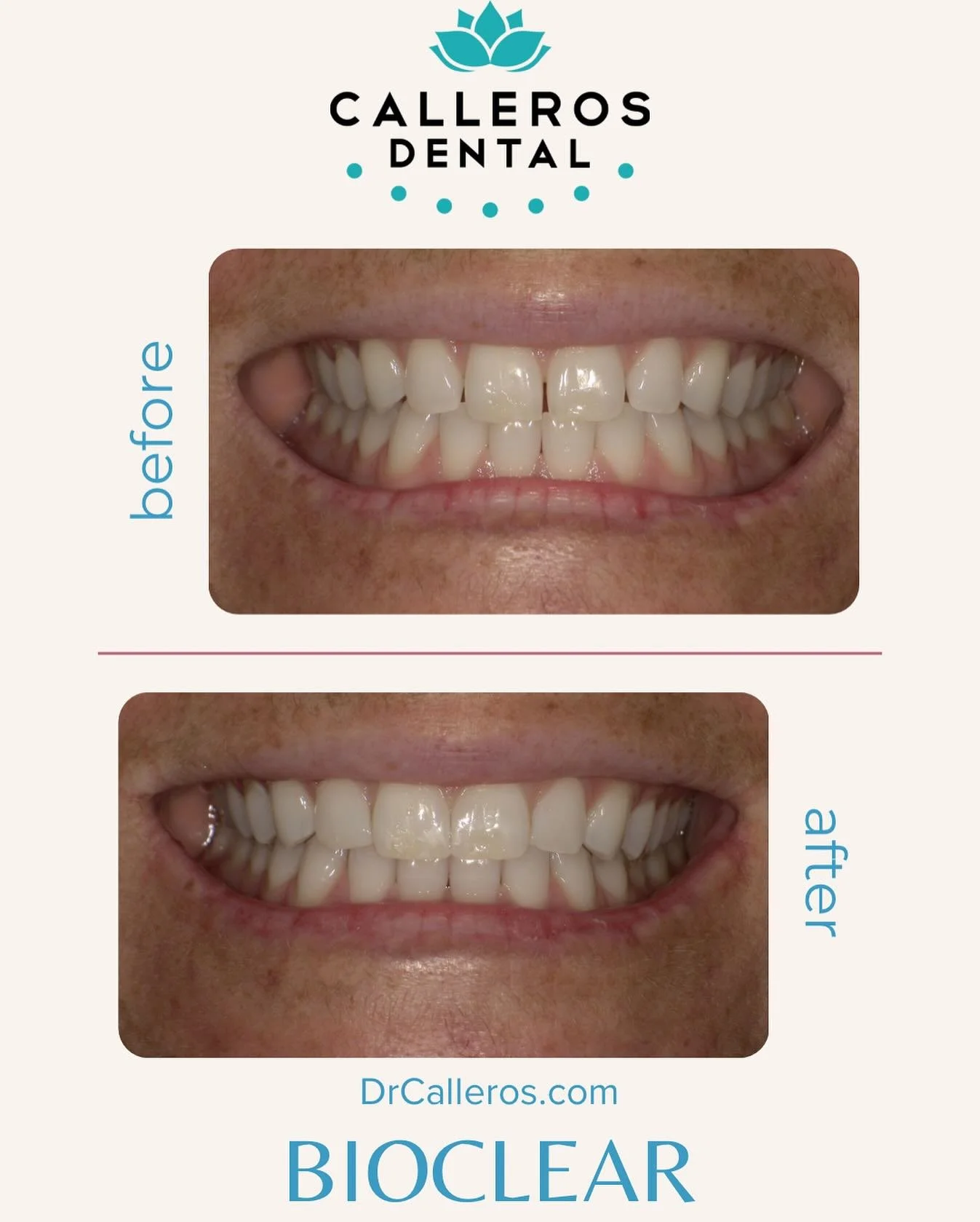 Dr. Calleros created a quick mockup today to help a patient visualize how her smile would look after closing the gaps between her upper front teeth with Bioclear. The patient has diastemas (spaces between the teeth) and wanted to see a preview before