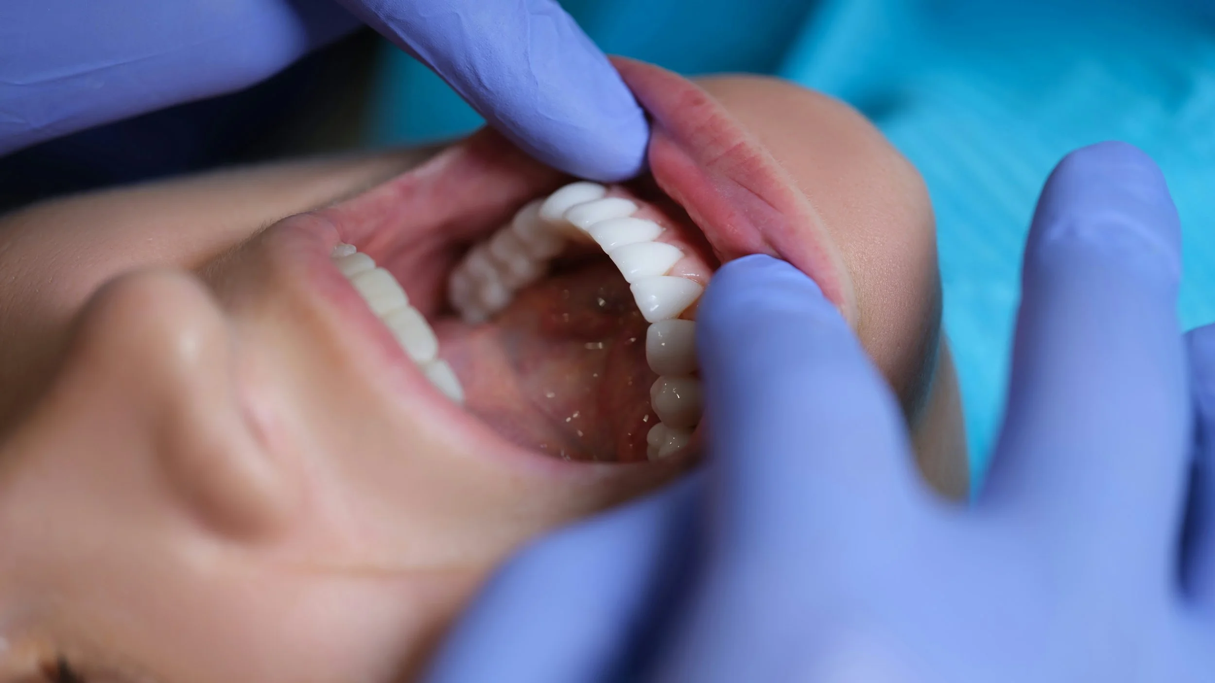 How Soft Tissue Grafting Can Restore Your Gums and Protect Your Smile