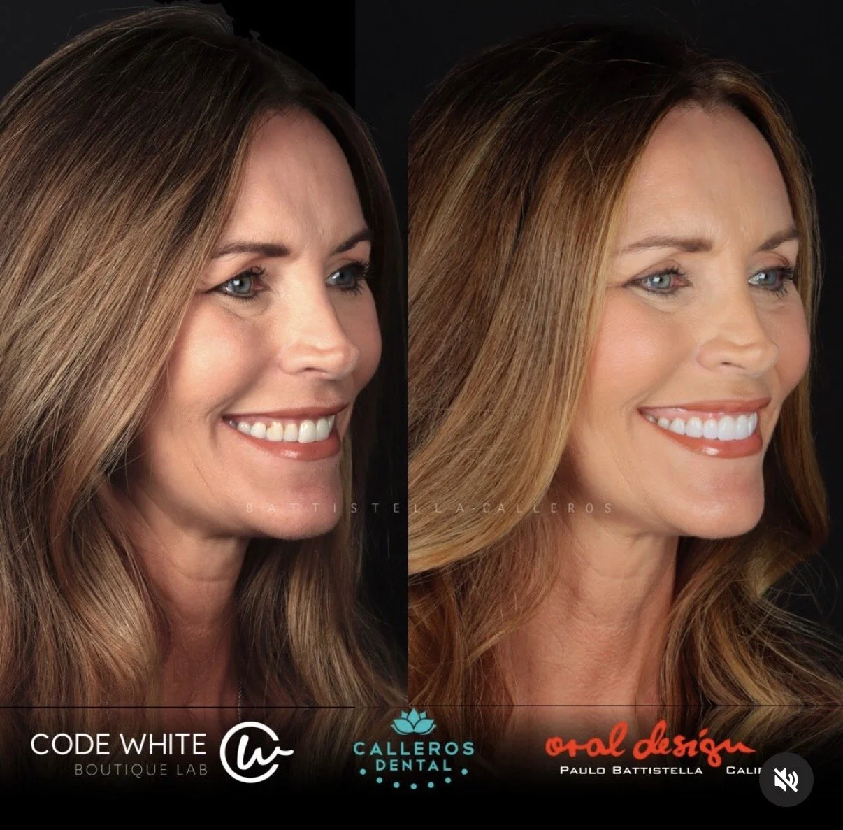 Our Patient Stephanie’s Journey with Veneers