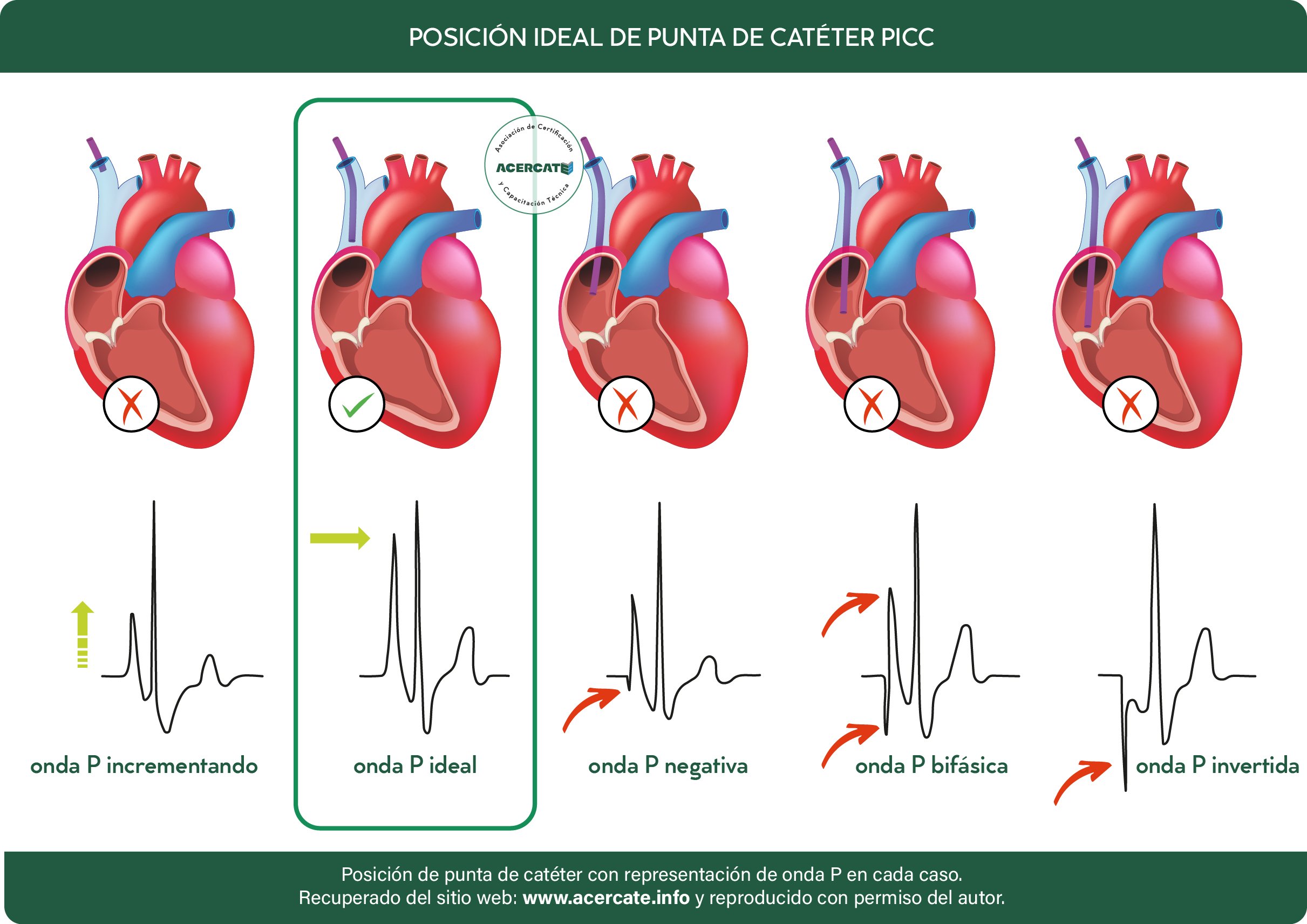 Diagrama que muestra la posición ideal de una punta de catéter PIC en el corazón, con diferentes formas de ondas P en un electrocardiograma, indicando la posición correcta, P ideal, P negativa, P bifásica e invertida. ACÉRCATE Para PICC
