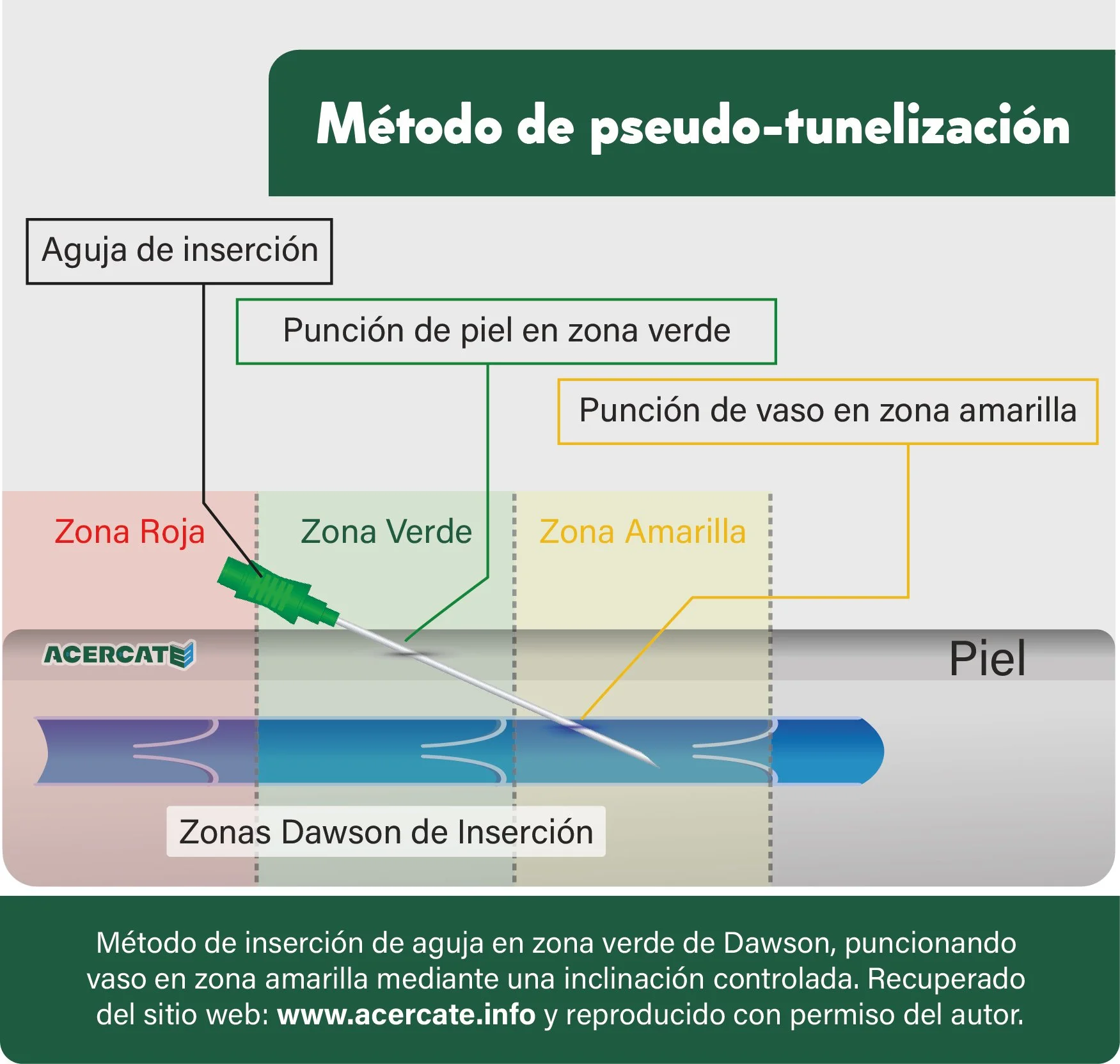 Diagrama del método de pseudo-tunealización para la inserción de aguja en la zona verde, amarillo y roja de la piel, con instrucciones y zonas de inserción. ACÉRCATE Asociación para certificación y capacitación Técnica Catéter PICC