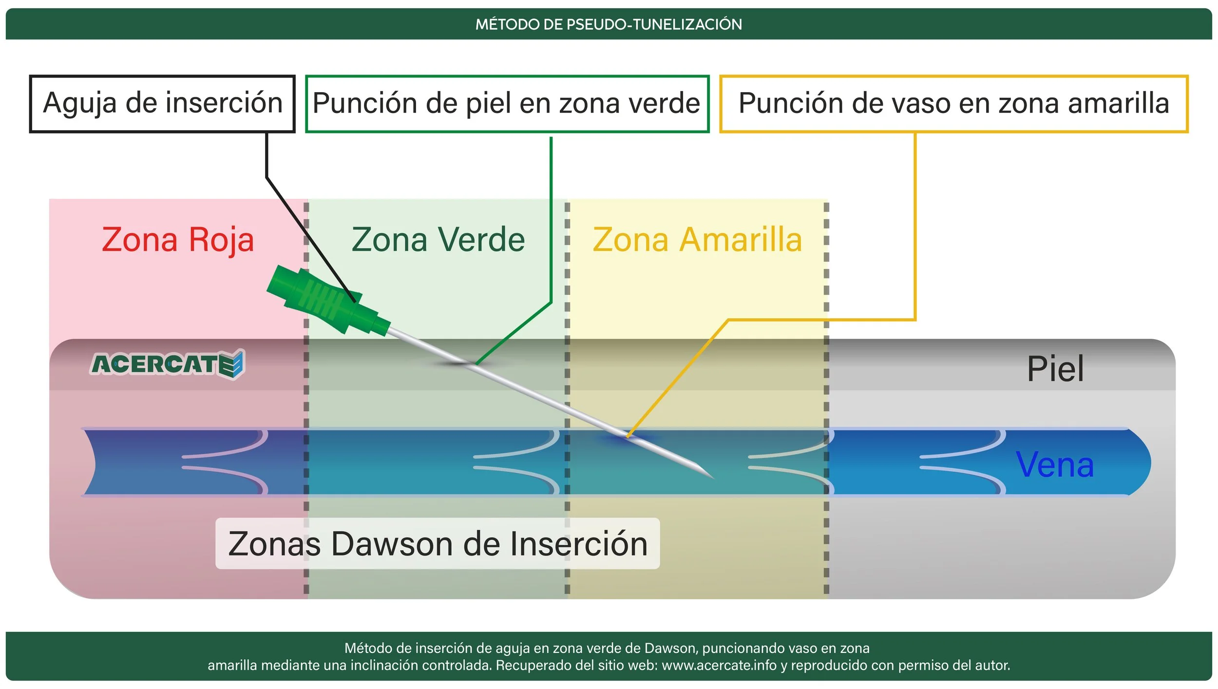pseudotunelizacion slide.jpg