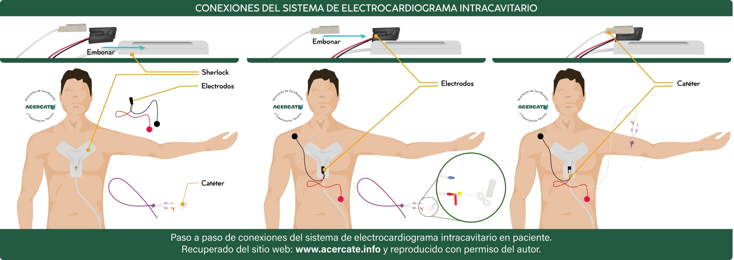 Conexiones del sistemaelectrocardiograma intracavitario