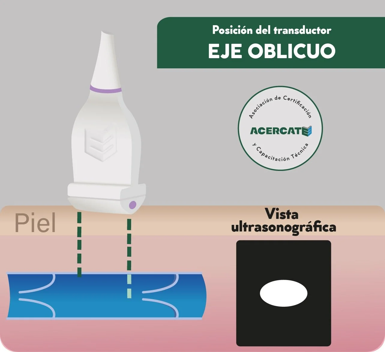 Imagen que explica la posición del transductor en eje oblicuo para vista ultrasonográfica en piel y tejido subyacente, con un dibujo de un dispositivo de ultrasonido y un esquema de la piel y capa subyacente. ACÉRCATE para PICC