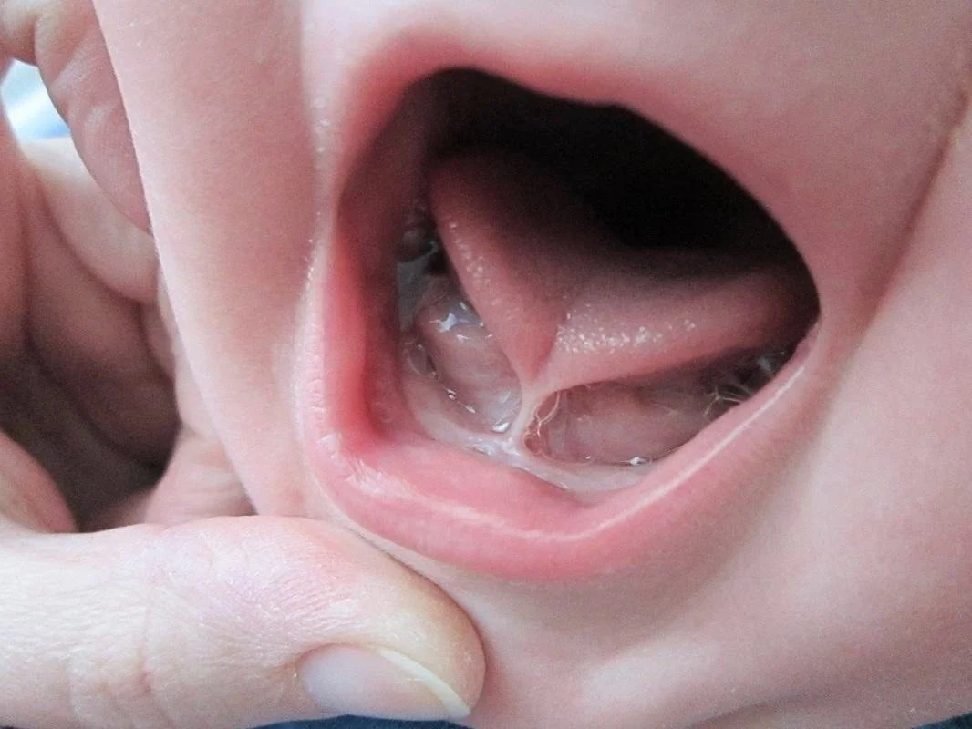 What is a Tongue Tie? Understanding the Condition and Why Treatment Matters